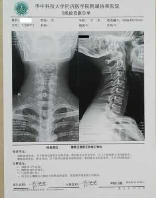 脊椎有问题拍什么片子-脊椎病拍啥片效果好-图3