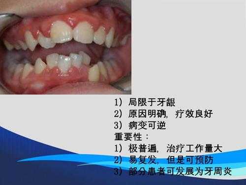 慢性牙周炎怎么治疗效果好,慢性牙周炎怎么才能治好 -图3