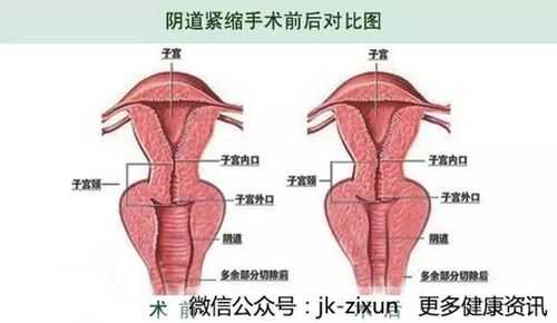 阴道紧缩术那种效果好的简单介绍-图1