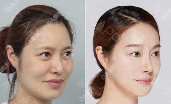 面部提升多久能恢复-图2