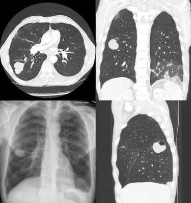 肺aah是什么-肺As是什么-图1