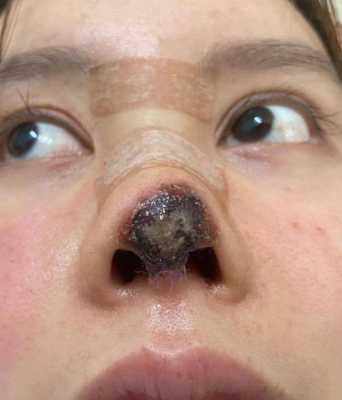 黑鼻头治疗-图3