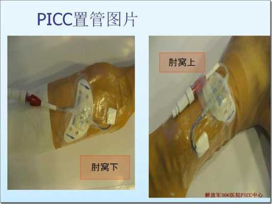 picc穿刺消毒用什么消毒液 picc穿刺包选择什么消毒-图2