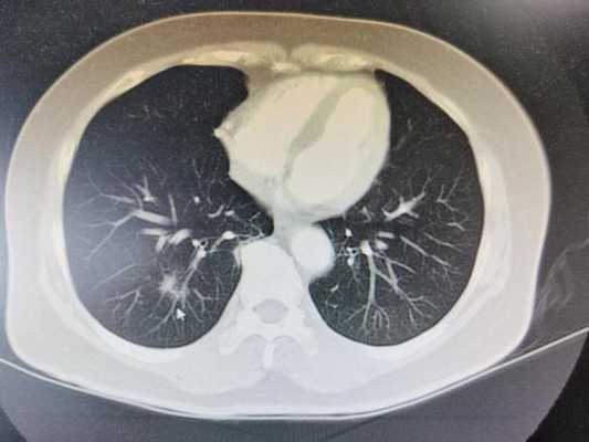 咳嗽需要拍片-咳嗽应该拍片子还是做CT效果好-图2