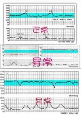  胎心监测仪fm是什么「fm胎心监护参数」-图3