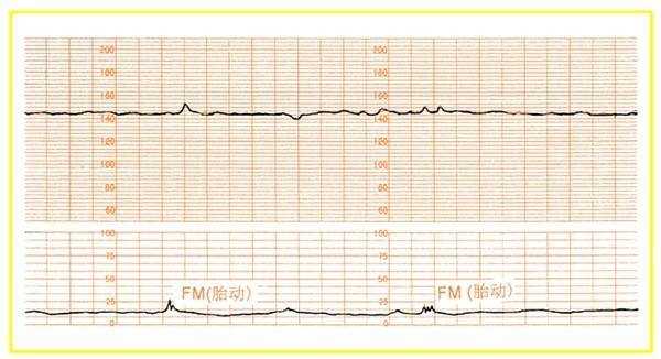  胎心监测仪fm是什么「fm胎心监护参数」-图1