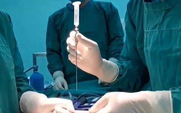 腹腔镜穿刺技巧视频-腹腔镜用什么穿刺-图3