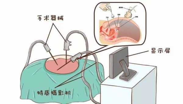 腹腔镜穿刺技巧视频-腹腔镜用什么穿刺-图1