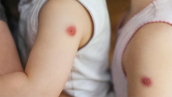  打疫苗的疤红肿「打疫苗的疤红肿了怎么办」-图1