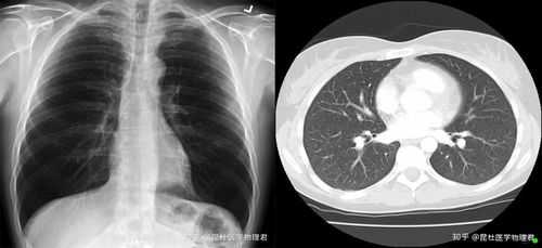 新型肺炎胸片是什么样子的（新冠肺炎肺部胸片特点）-图3