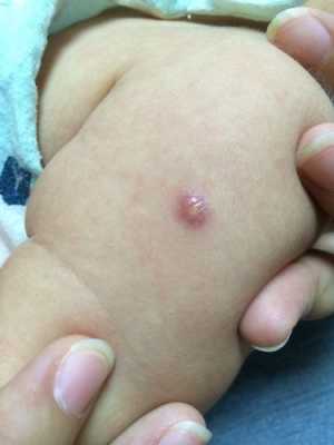种豆子疫苗有个小脓包怎么办-种豆疫苗疤痕图片-图3