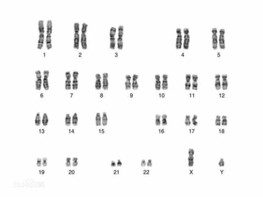 21号环什么样,20号环状染色体综合征 -图1