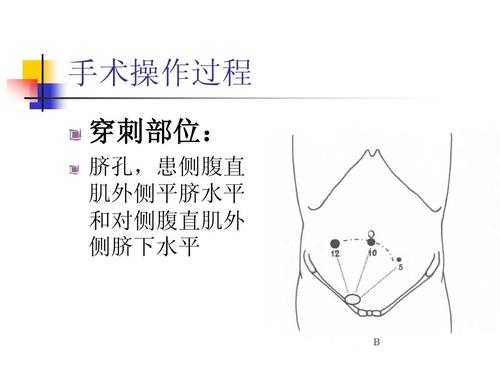 腹腔穿刺操作方法 腹腔穿刺器俗称什么-图1
