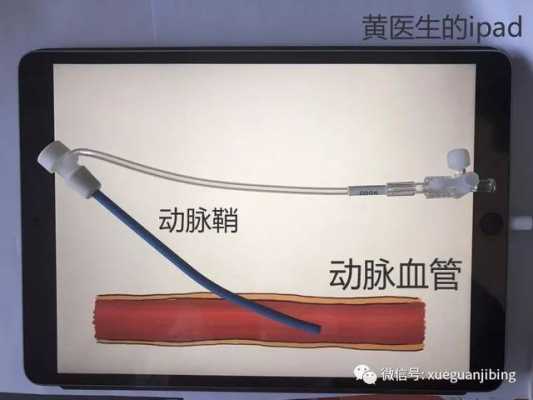股动脉鞘管有什么作用（拔除股动脉鞘管）-图2