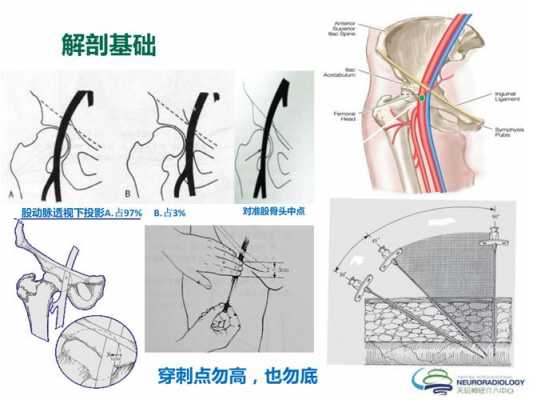 股动脉鞘管有什么作用（拔除股动脉鞘管）-图1