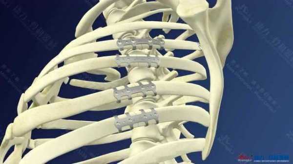 取肋骨接骨板的器械叫什么,取肋骨手术怎么做 -图1