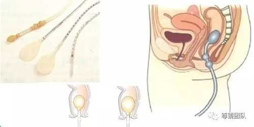 肛门牵开器作用是什么,肛门牵拉疼是什么原因 -图3