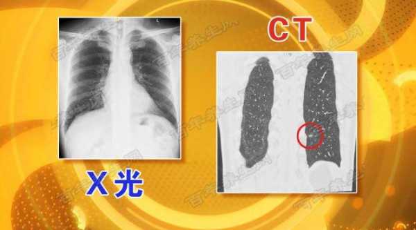 中国什么时候用x光医用的,x光检查什么时候发明 -图2