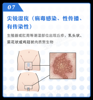 怎么样治疗外阴疱疹效果好的简单介绍-图2