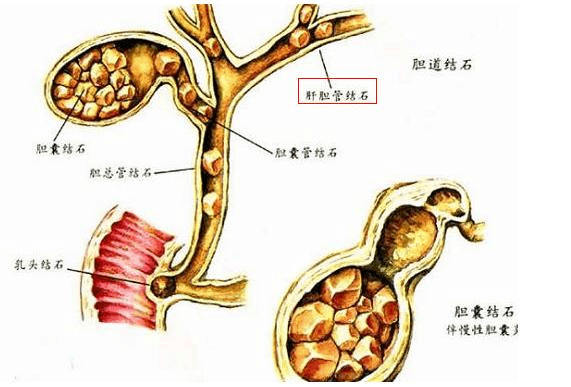 肝内胆管结石怎样治疗效果好_肝内胆管结石怎样治疗效果好些-图2