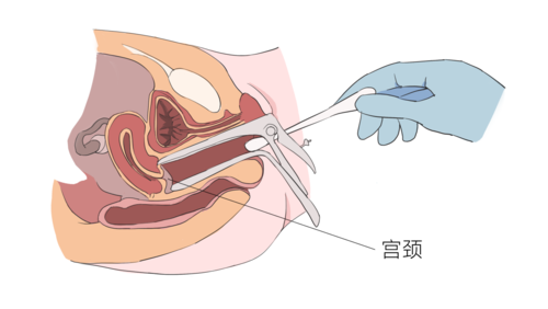 子宫扩张术是什么意思 子宫扩张棒干什么用的-图3