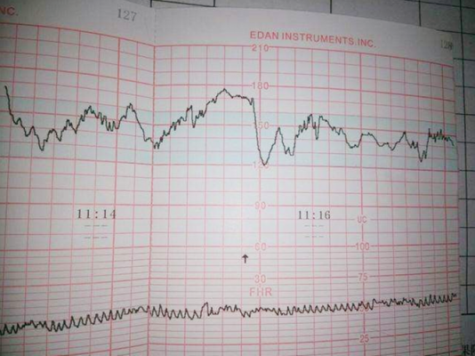胎心监护有vd波减速波图-胎心监护vd波是什么-图2
