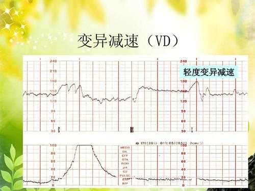 胎心监护有vd波减速波图-胎心监护vd波是什么-图3
