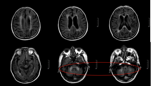 磁共振脑部白色代表什么,脑部磁共振白色区域 -图1