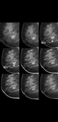 乳腺断层扫描是什么_乳房断层扫描-图2