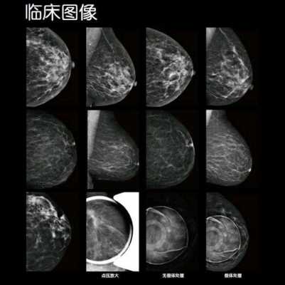 乳腺断层扫描是什么_乳房断层扫描-图1