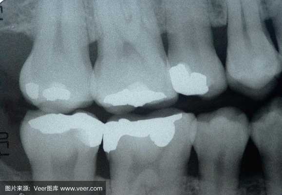 牙科照x光对身体好不好-牙科x光是什么样的-图3