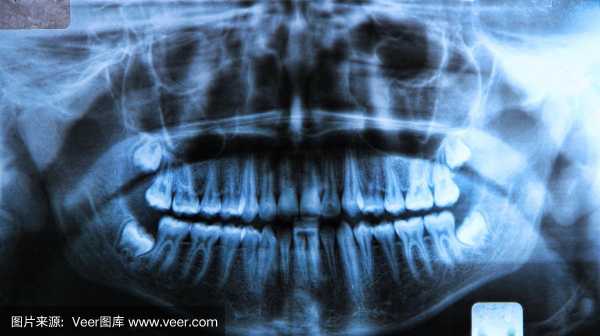 牙科照x光对身体好不好-牙科x光是什么样的-图1