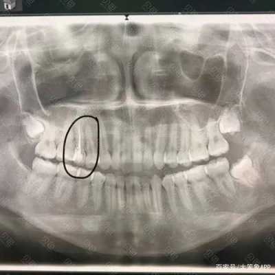 牙科照x光对身体好不好-牙科x光是什么样的-图2