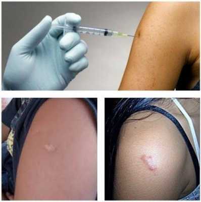  疫苗旧疤痕「疫苗伤疤是怎么回事」-图3