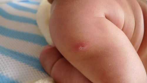 宝宝疫苗发脓（宝宝疫苗出脓）-图1